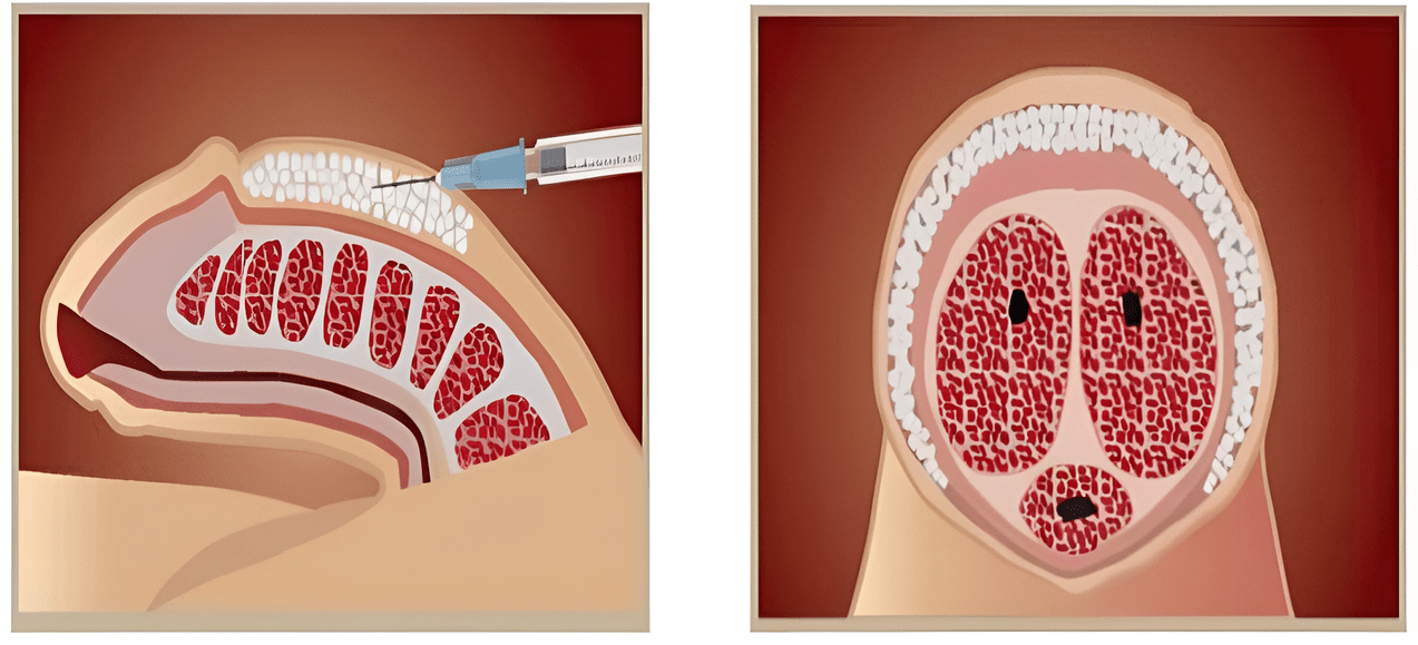 Areas of filler injection