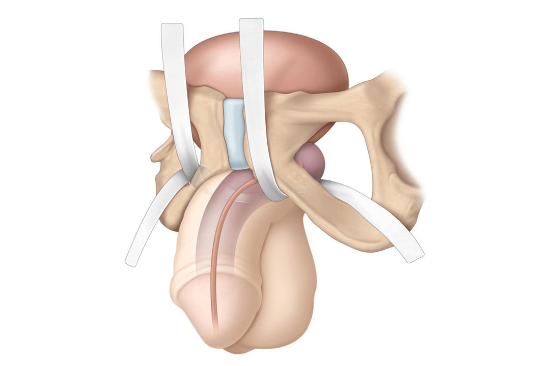 Sites being examined for the presence of filler