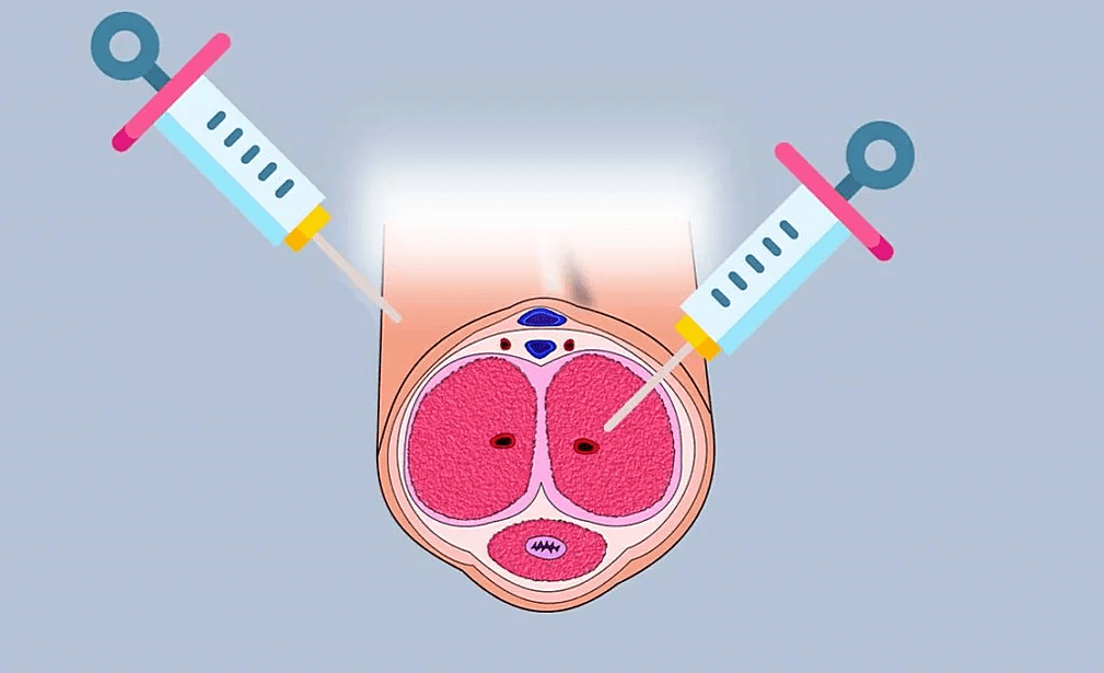 Sites for injection of hyaluronic acid